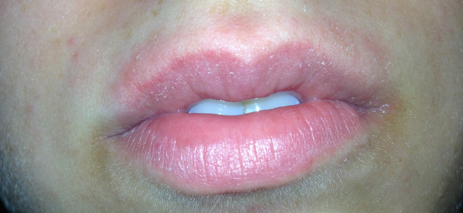 Dry Patch Of Skin Above My Lip