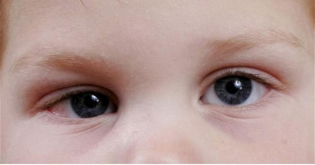 Lazy Eye Causes, Diagnosis And Treatment | Health And Beauty