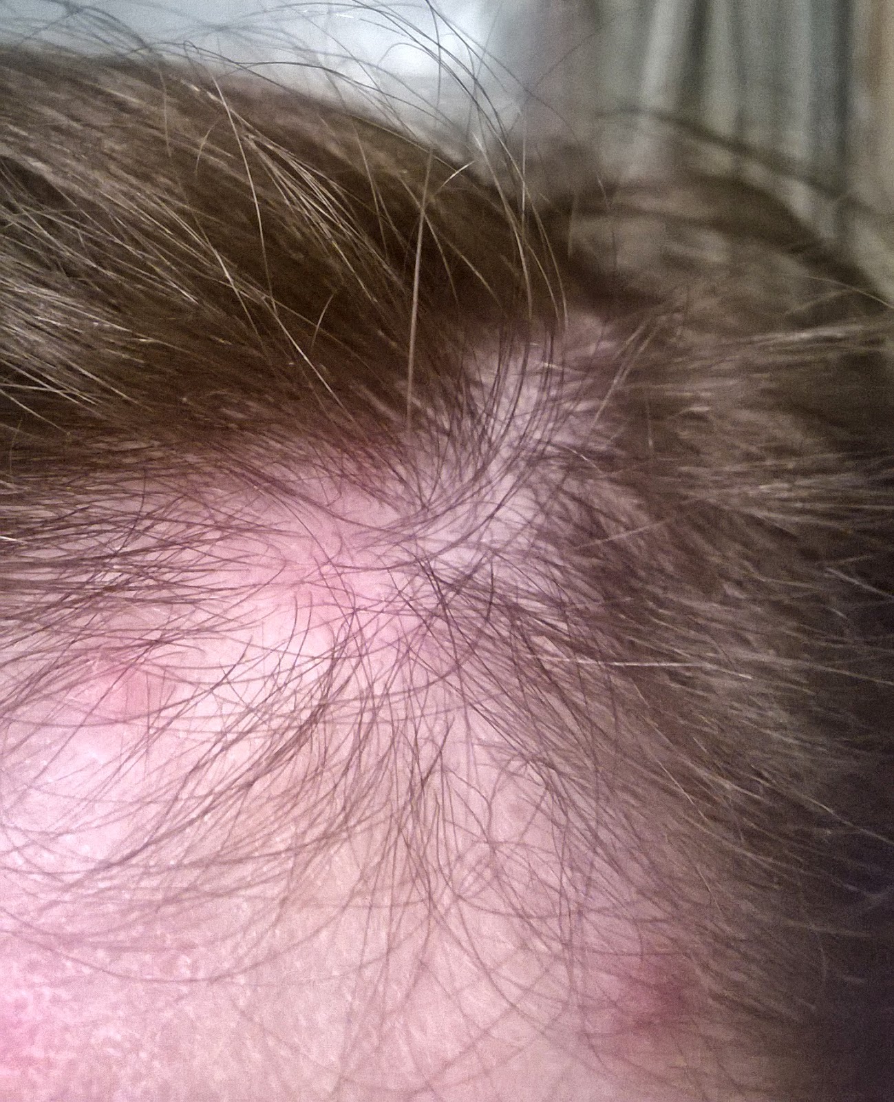 You're not crazy. you're sick My Lovely Discoid Lupus Pics