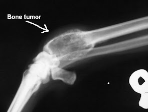 Bone tumour