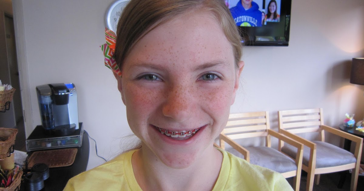 Nelson Nickels Braces Off!