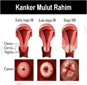 Strategi Baru Pencegahan Kanker Serviks