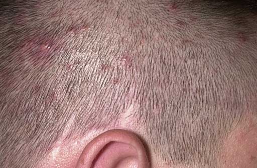 Scalp Folliculitis Treatment Using Organic Coconut Oil Scalp Folliculitis Treatment Using Organic Coconut Oil