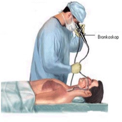 bronkoskopi nedir, bronkoskopi işlemi, bronkoskopi ne demek