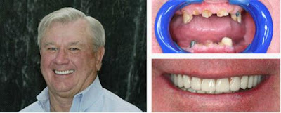 All on Four Dental Implants All on Four Dental Implants