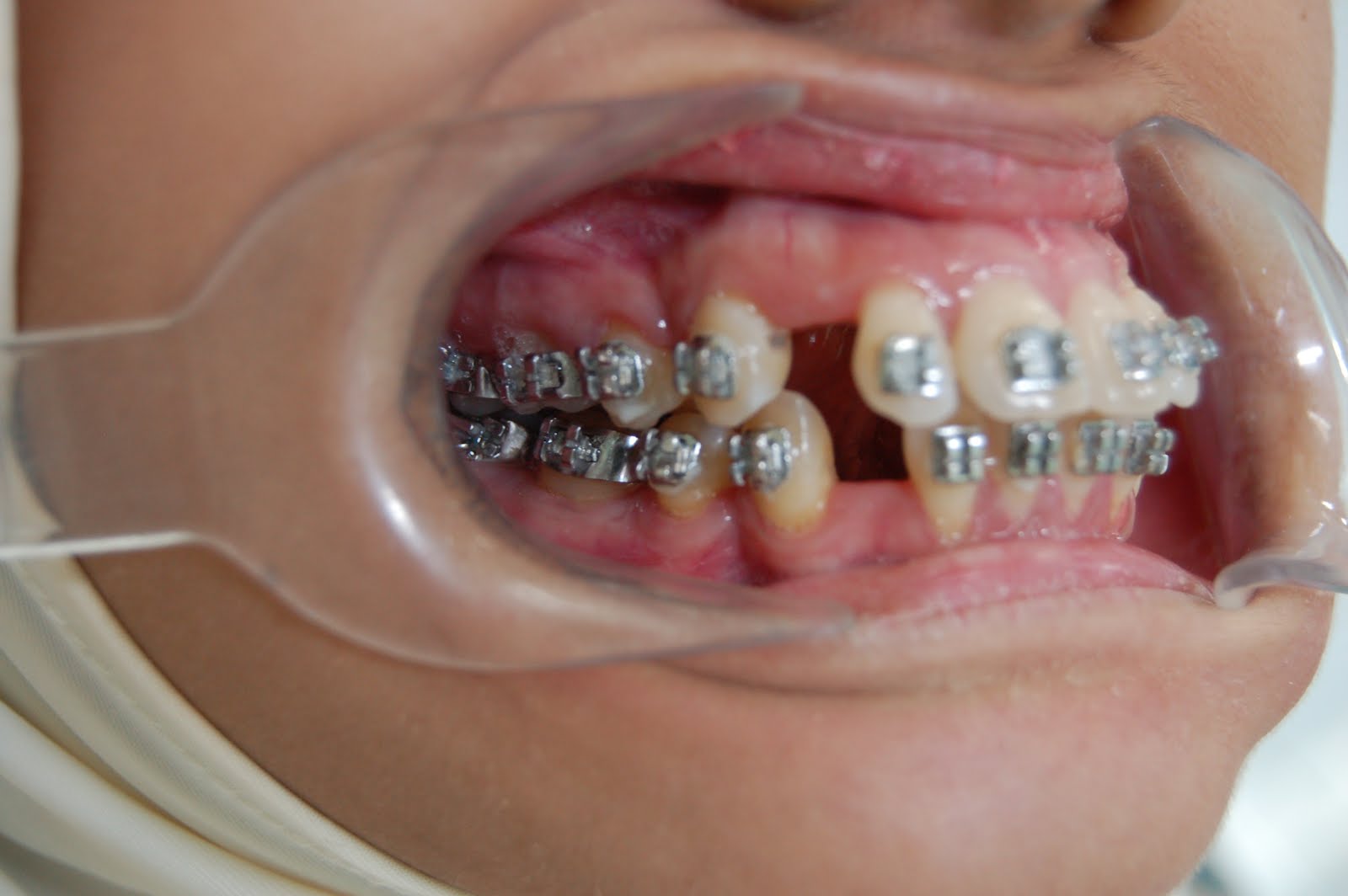 Protruding Upper Lip