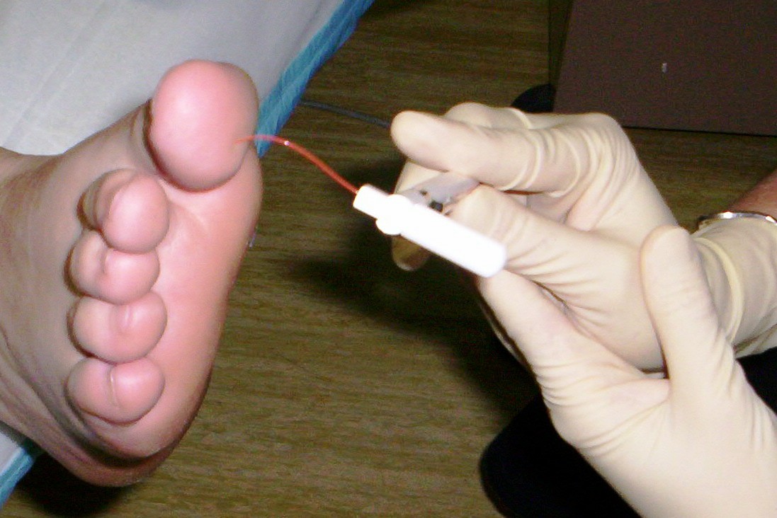 foot talk Diabetes, peripheral neuropathy and foot screening Check it out