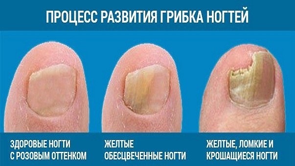 Грибок ногтя начальная стадия на ноге Грибок ногтя начальная стадия на ноге