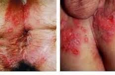 obat herbal gatal kadas obat herbal gatal kadas