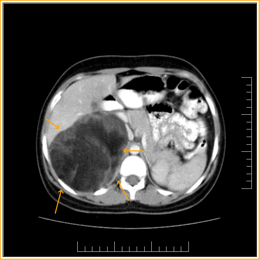 adrenal myelolipoma ct radiopaedia