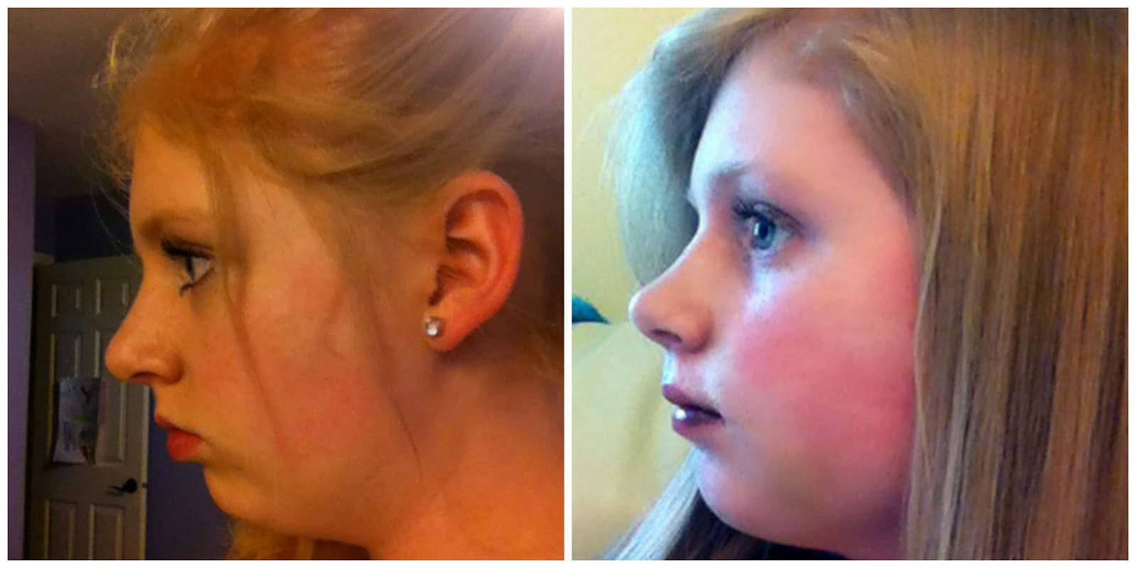 jaw surgery double before bite pain teeth katie removal