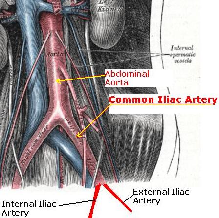 Iliac Arteries
