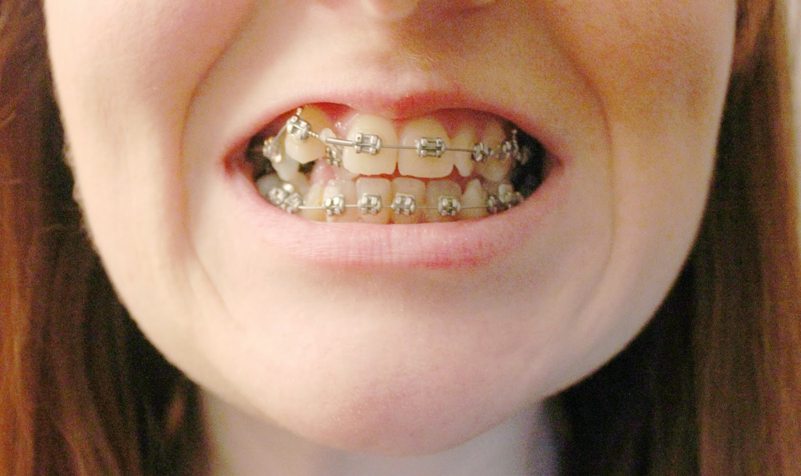 The brace lady My first month in braces