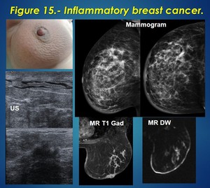 Cancer Detail Care: Inflammatory Breast Cancer