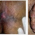 Obat Ambeien External thumbnail