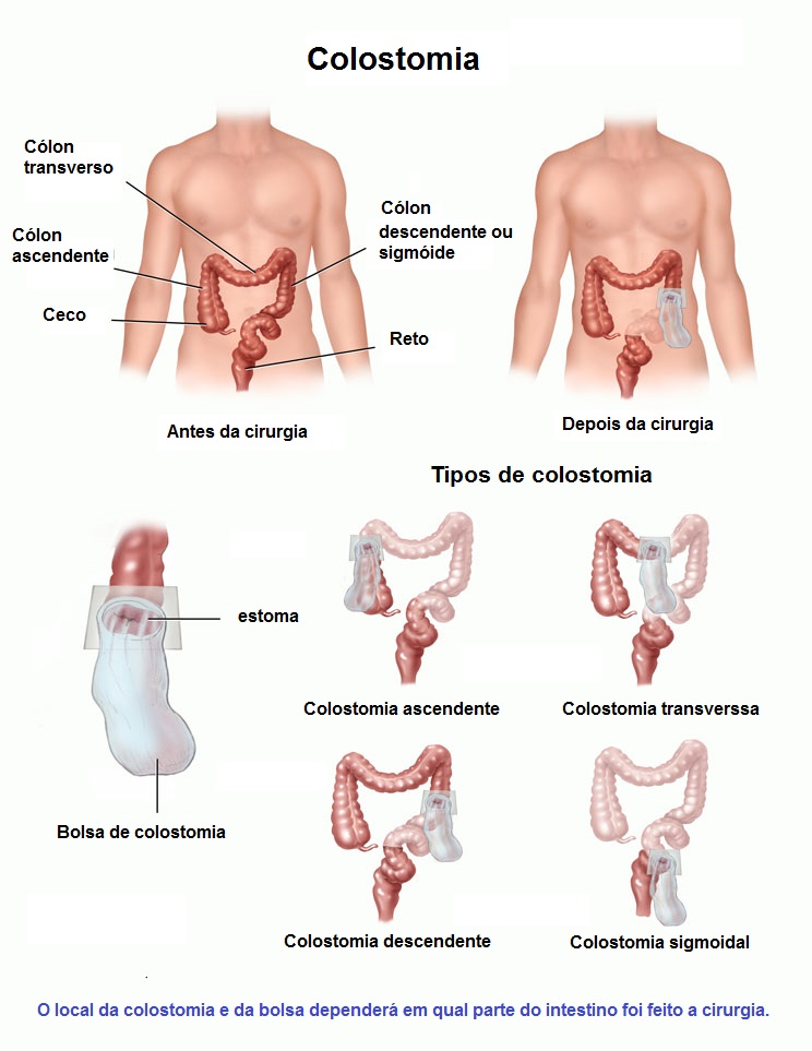 Tipos de colostomia