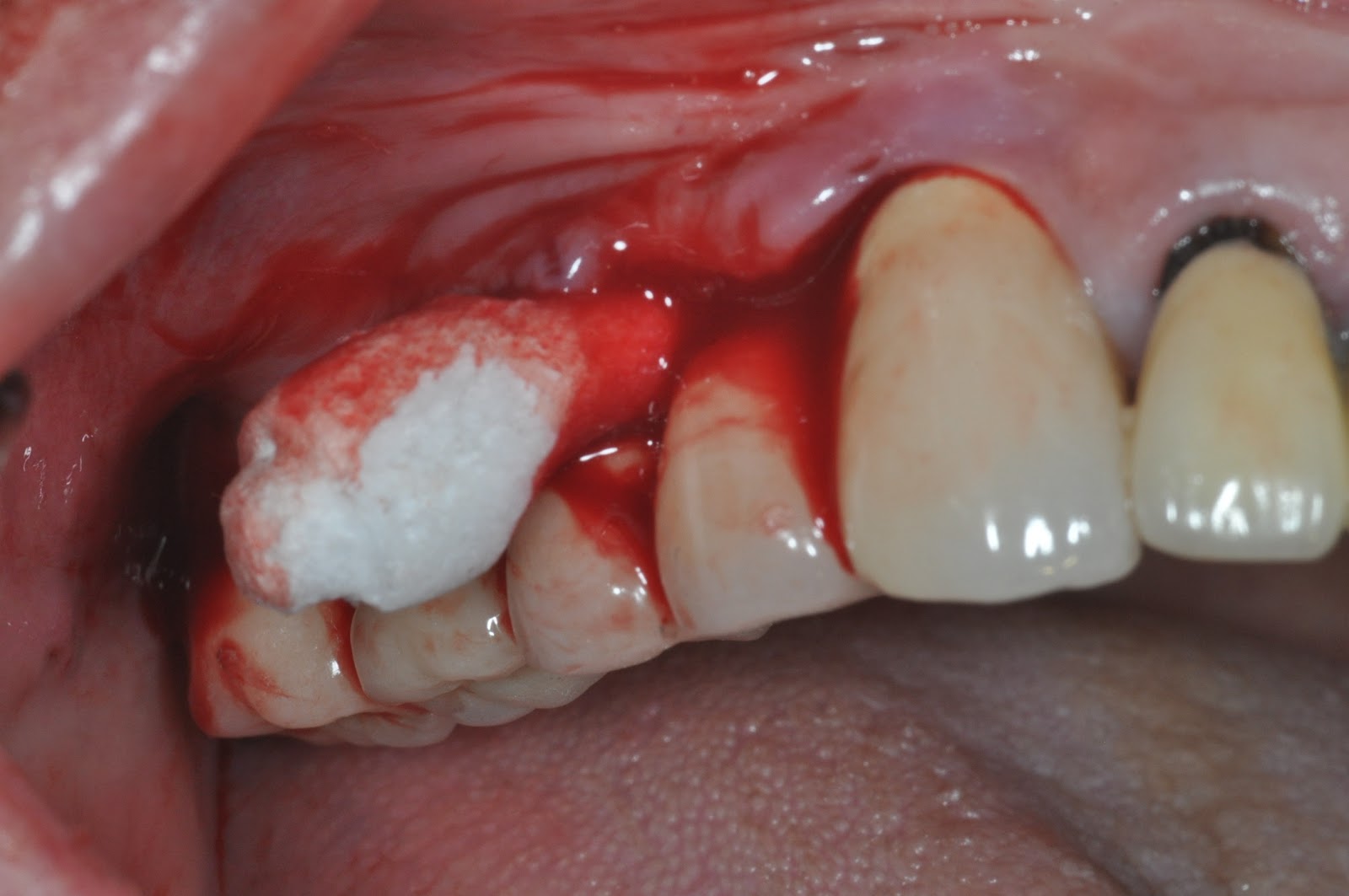 debridement DriverLayer Search Engine