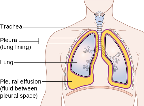 Pleural Effusion Medical Silver