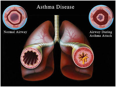 Asthma Disease PPT