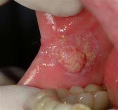 Rough Patch Of Skin On Roof Of Mouth
