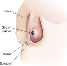 Testicular Cancer Picture