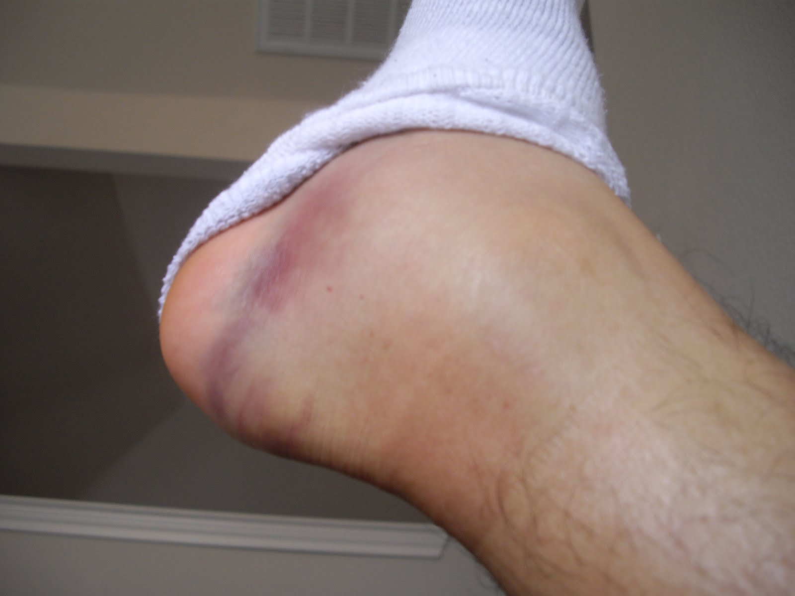 Swollen Achilles Tendon