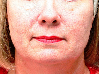 Rosacea around Mouth