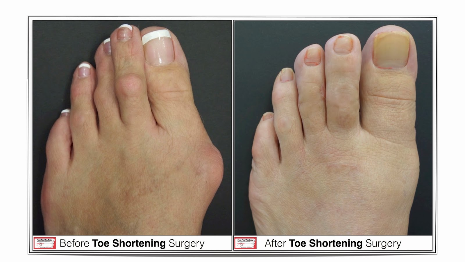 Toe Shortening Procedure Long Ugly Toes Foot First Can Give You a