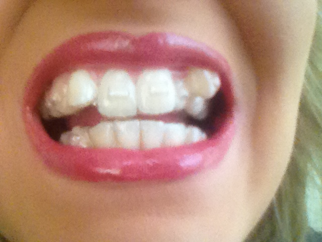 invisalign attachments