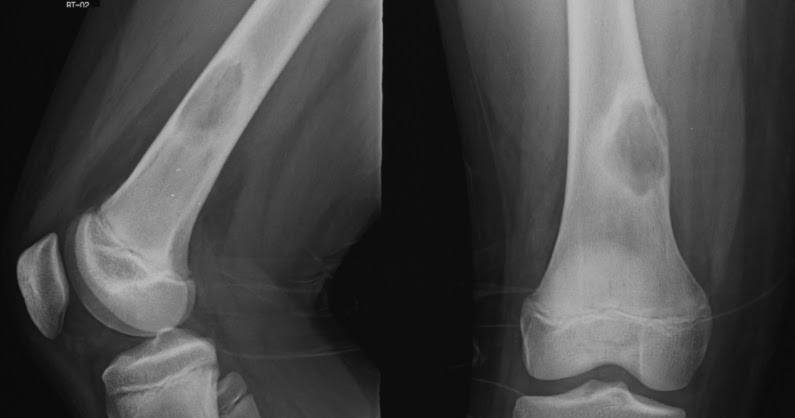 bone cyst ct scan