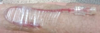 Infusion catheter inserted into my arm and the line secured with clear tape.  The IV solution will be administered via the plug on the right hand side.