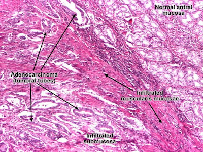 Histology and Explanation of Gastric carcinoma, intestinal type