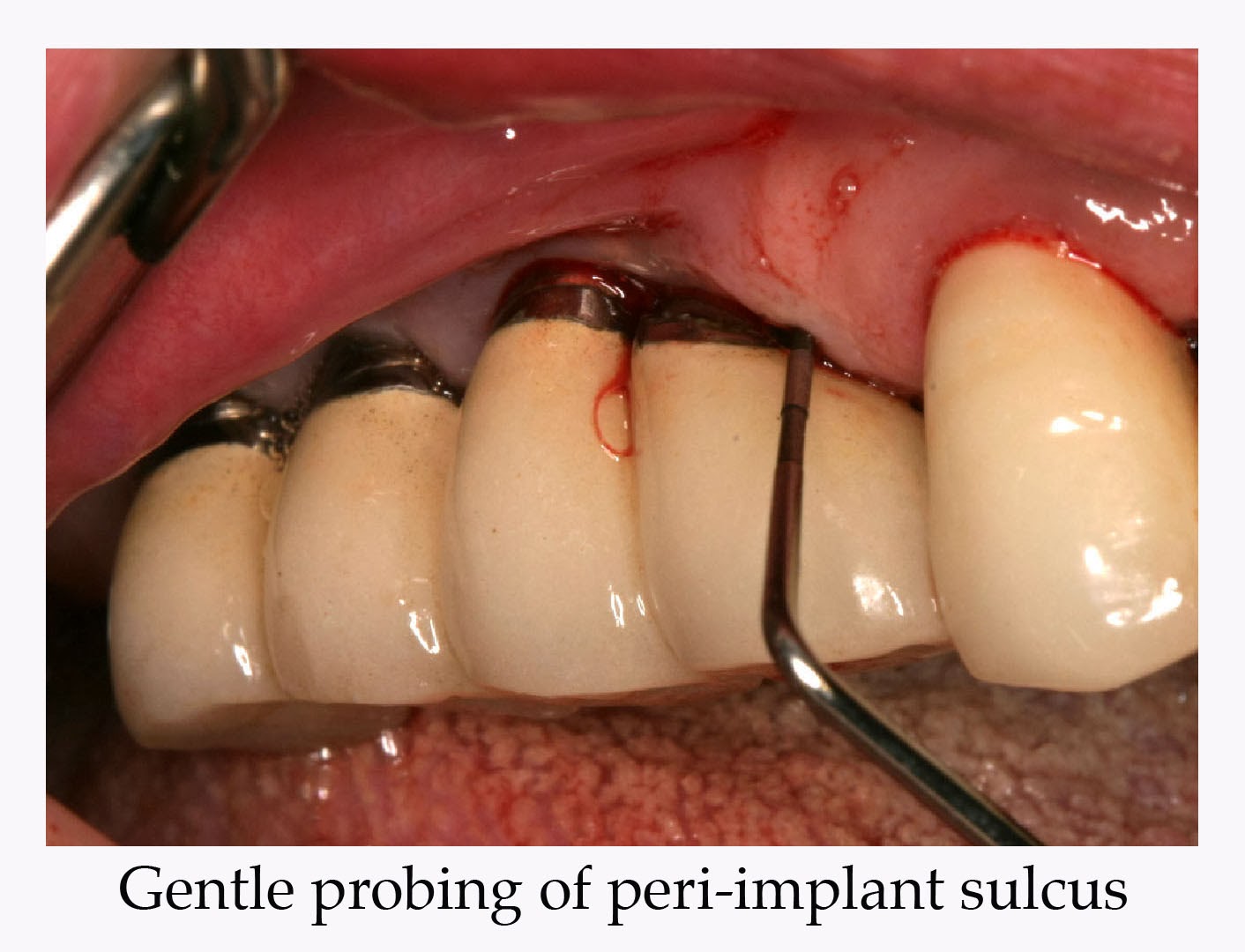 Implant Maintenance Periodontal Concepts vrogue.co