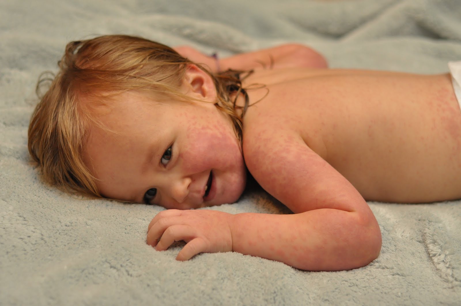 Huge Birthmark