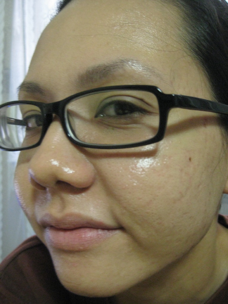 Secret Apple Cider Vinegar For Acne Scars
