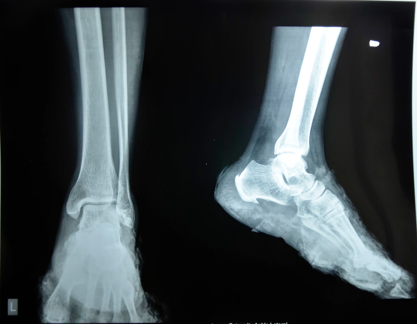 CRUSH INJURY FOOT, LOWER LIMB INJURIES AND LIMB SALVAGE MAJOR CRUSH