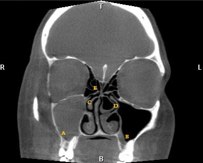 Ct+scan+sinus