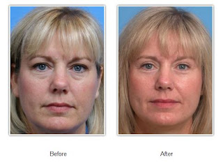 Before and After shots