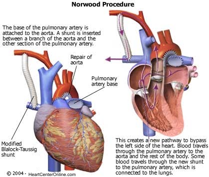 Stage 1 Norwood procedure