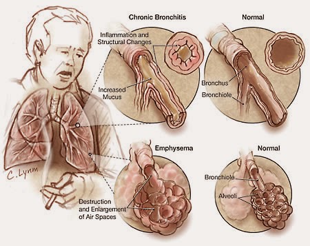 ICD 9 Code For Copd