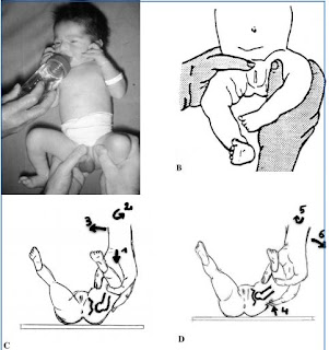 fracture de la clavicule chez l enfant