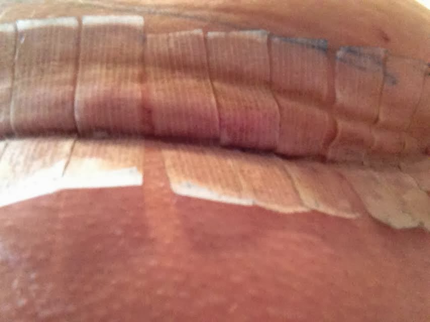 Cellulitis Infection From C Section Best Way To Rid Of Cellulite