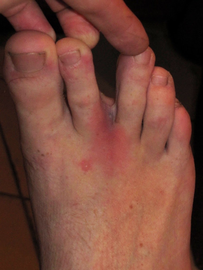 Crowned Eagle Research in KwaZulu-Natal: Tick Bite Fever