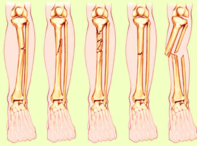 Asuhan Keperawatan pada pasien Fraktur