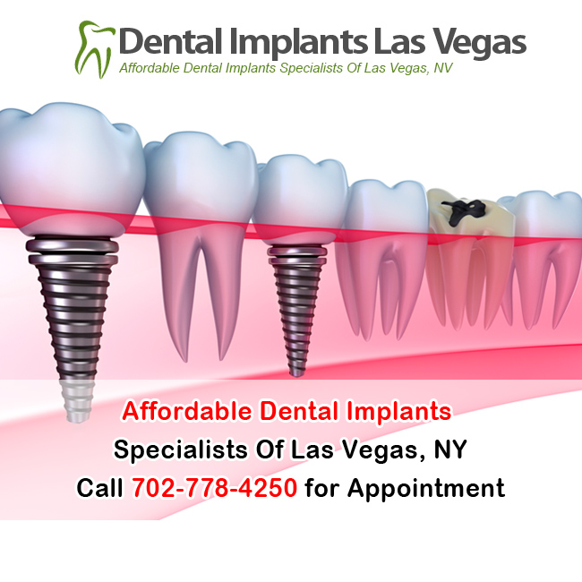 How to Choose A Good Dentist for Dental Implants Dental Implants Las
