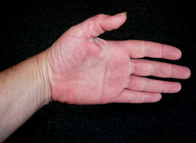 Topical steroid withdrawal edema