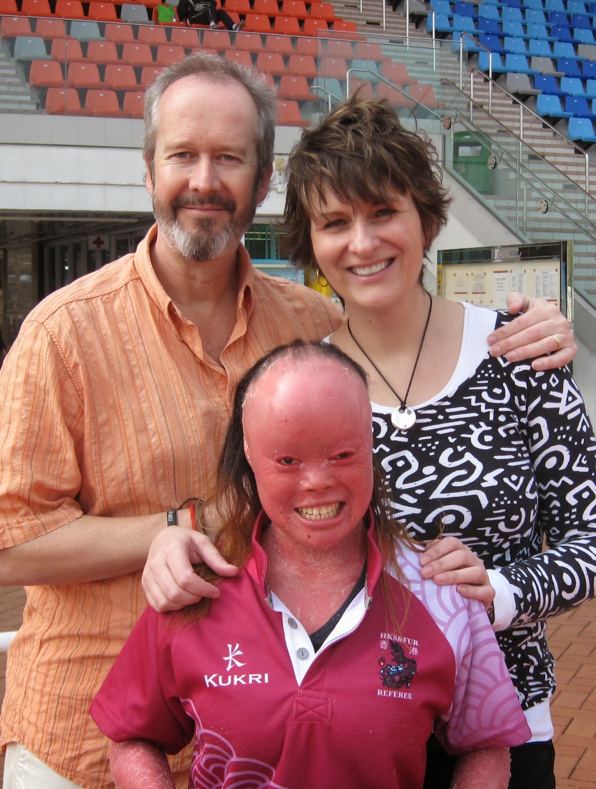 Mui, who has harlequin ichthyosis, with her parents