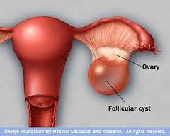 Ovary+Cyst