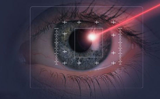 laser eye surgery