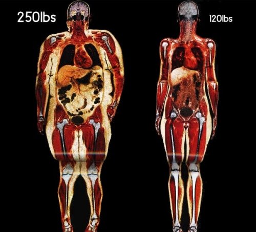 Diferencias entre una persona obesa y una normal